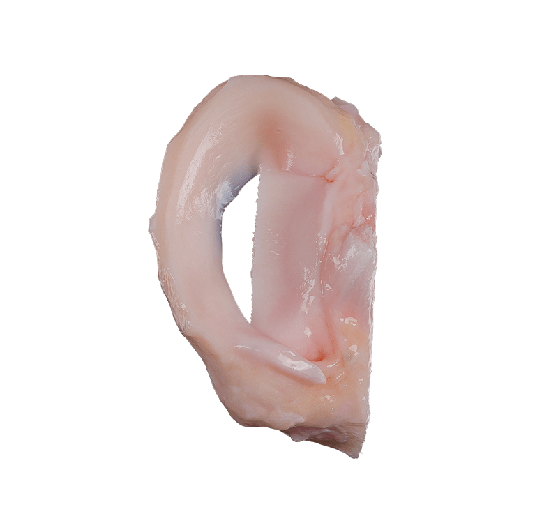 Soft Tissue Meniscal Allograft Transplantation Technique