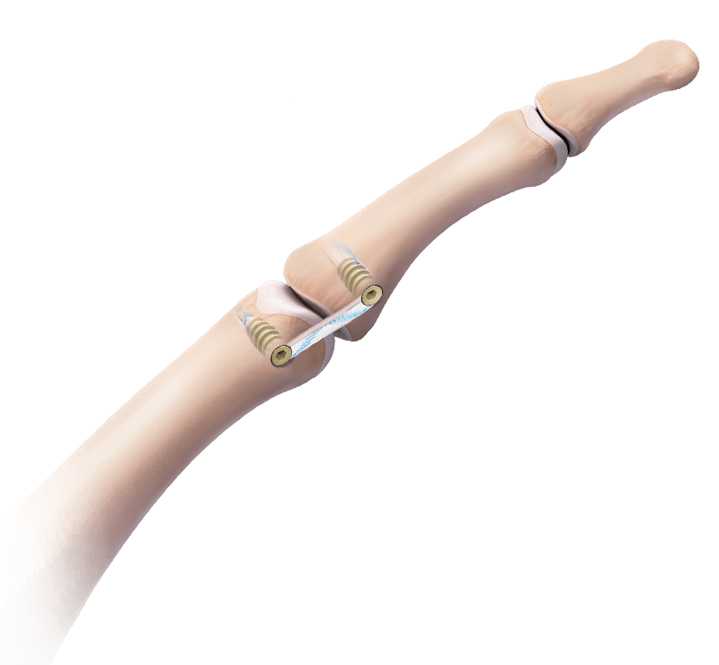 Reconstrução do ligamento colateral do polegar com Bio-Tenodesis™ 3 mm x 8 mm