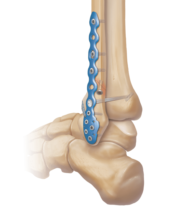 Titanium Ankle Fracture System