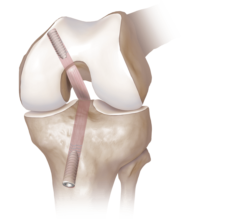 Transtibial PCL Reconstruction
