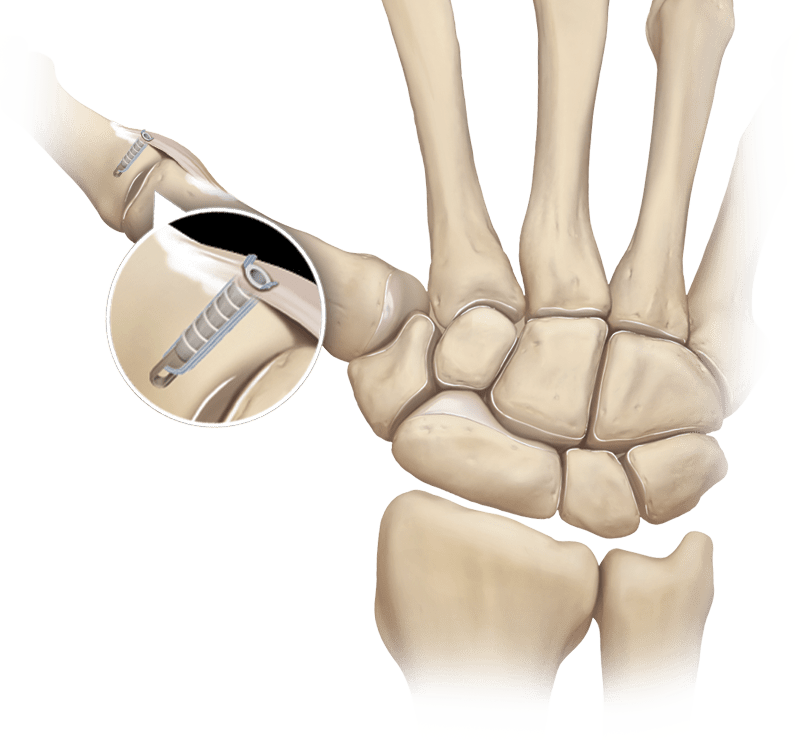 Reparo do ligamento colateral do polegar com PushLock<sup>®</sup> 2,5 mm