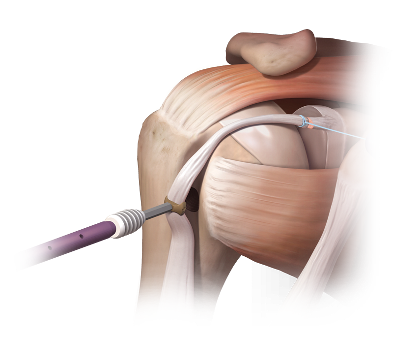 Тенодез сухожилия длинной головки двуглавой мышцы плеча. Тенодез длинной головки бицепса плечевого сустава. Теносиновит плечевого сухожилия. Тендинит сухожилия двуглавой мышцы.