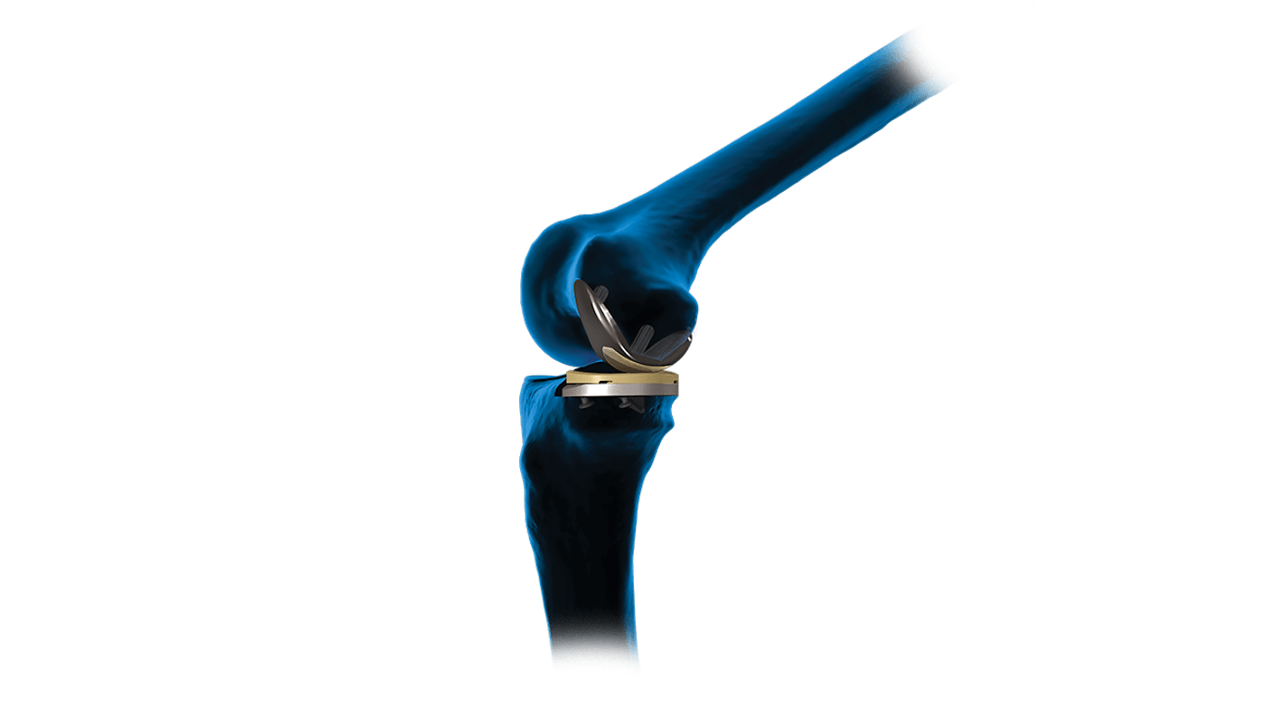 iBalance<sup>®</sup> UKA System 