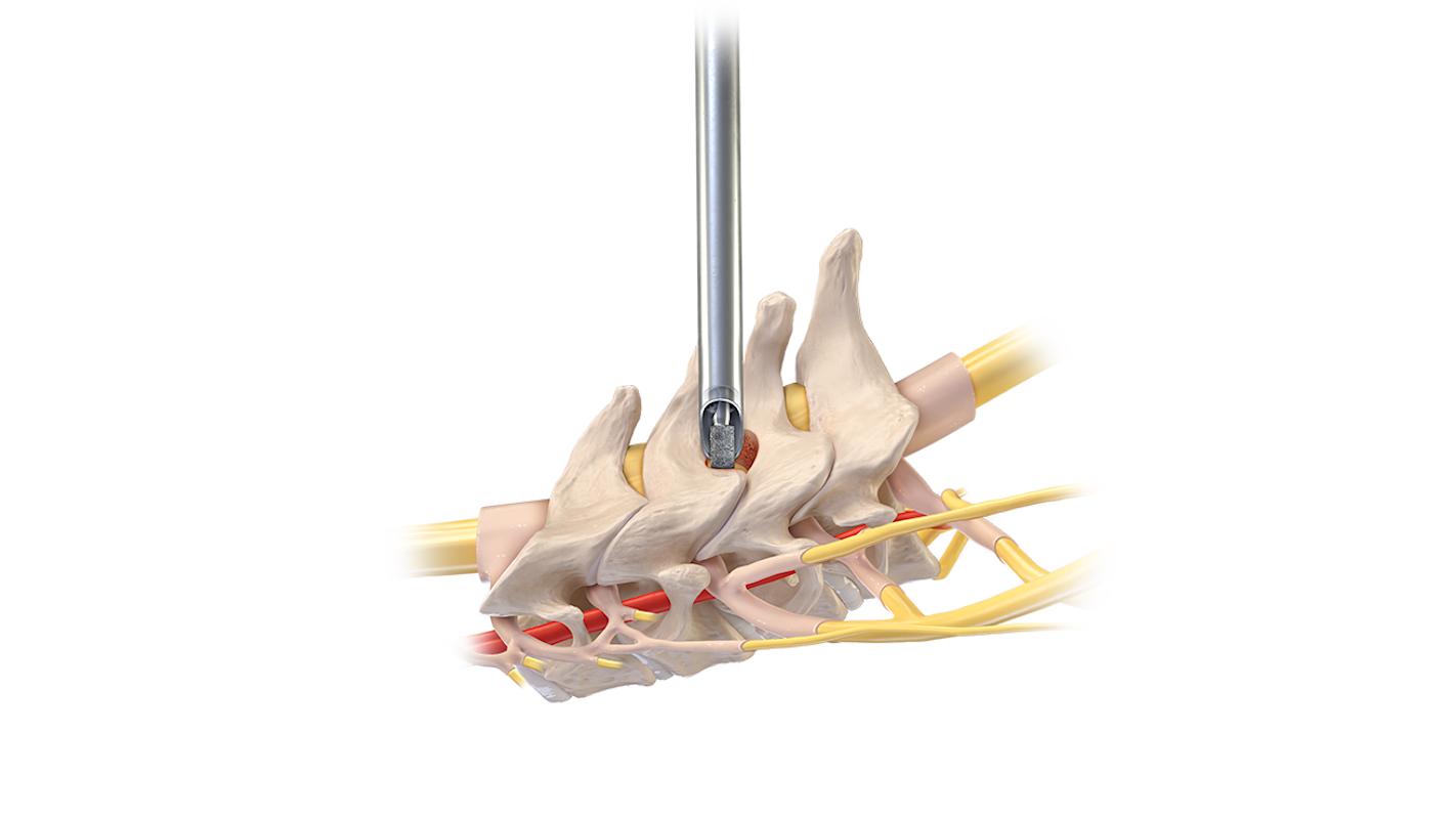 Cervical Foraminotomy and Decompression
