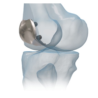 iBalance<sup>®</sup> PFJ System