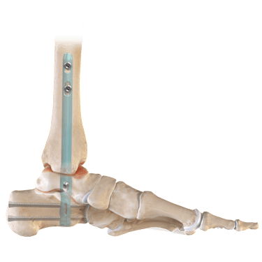 DualCompression Hindfoot Nail