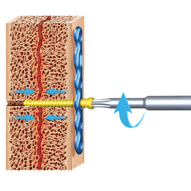 KreuLock™ Locking Compression Screws