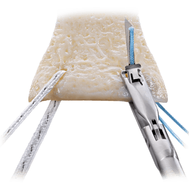ArthroFLEX<sup>®</sup> Decellularized Dermal Allograft