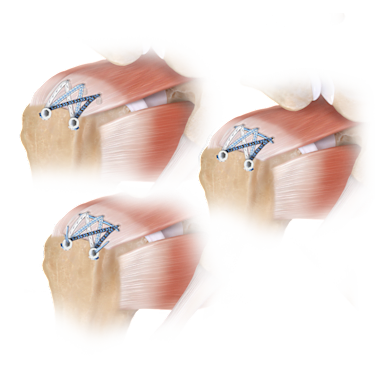 FiberTak® SpeedBridge™ Rotator Cuff Repair