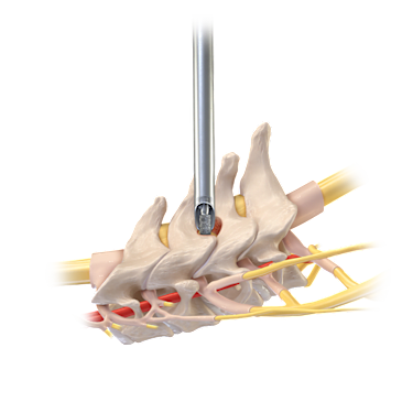 Cervical Foraminotomy and Decompression