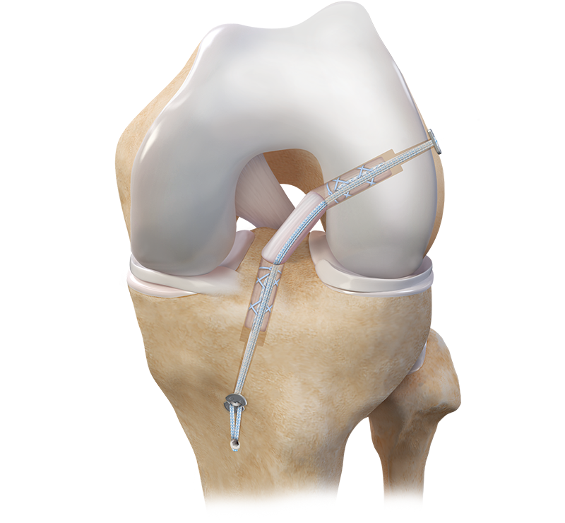 ACL Soft-Tissue Graft Fixation