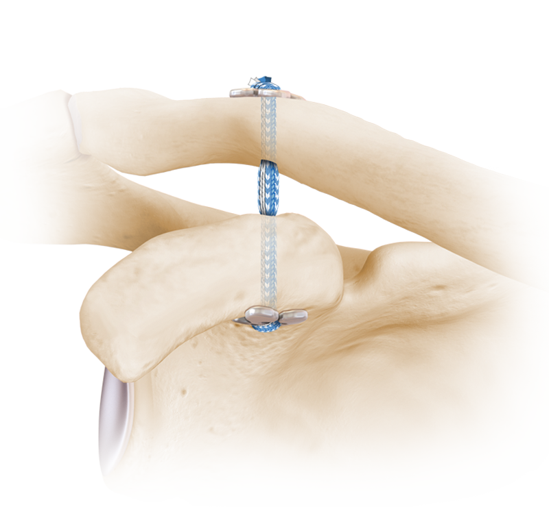 Acromioclavicular Joint Separation
