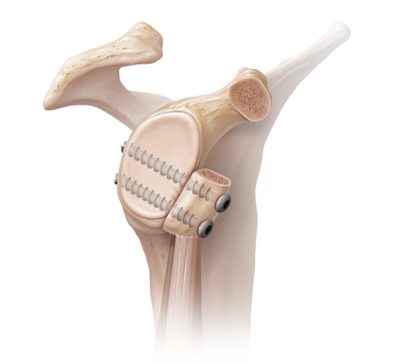 Glenohumeral Instability / Labral Tear 