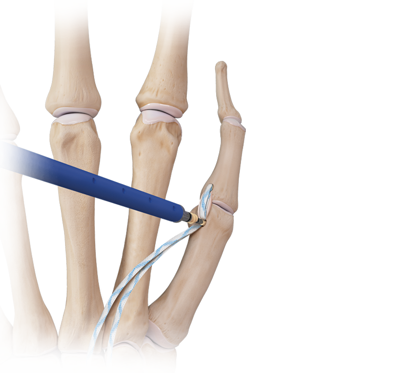 Hand/Wrist <em>Internal</em>Brace™ Ligament Augmentation Repair