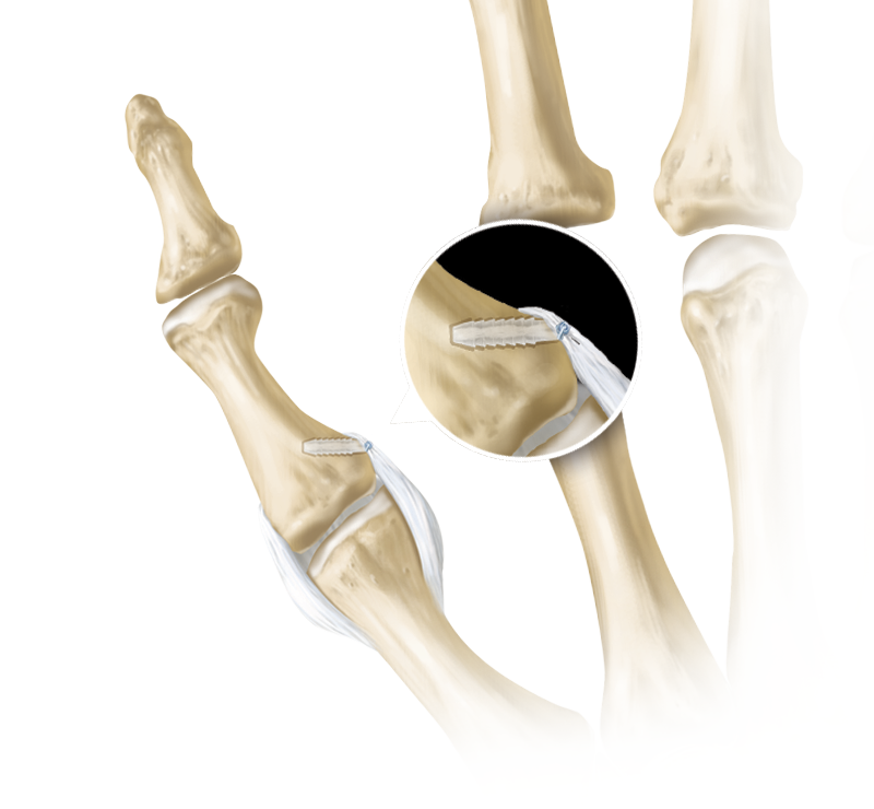 SutureTak<sup>®</sup> Thumb Collateral Ligament Repair