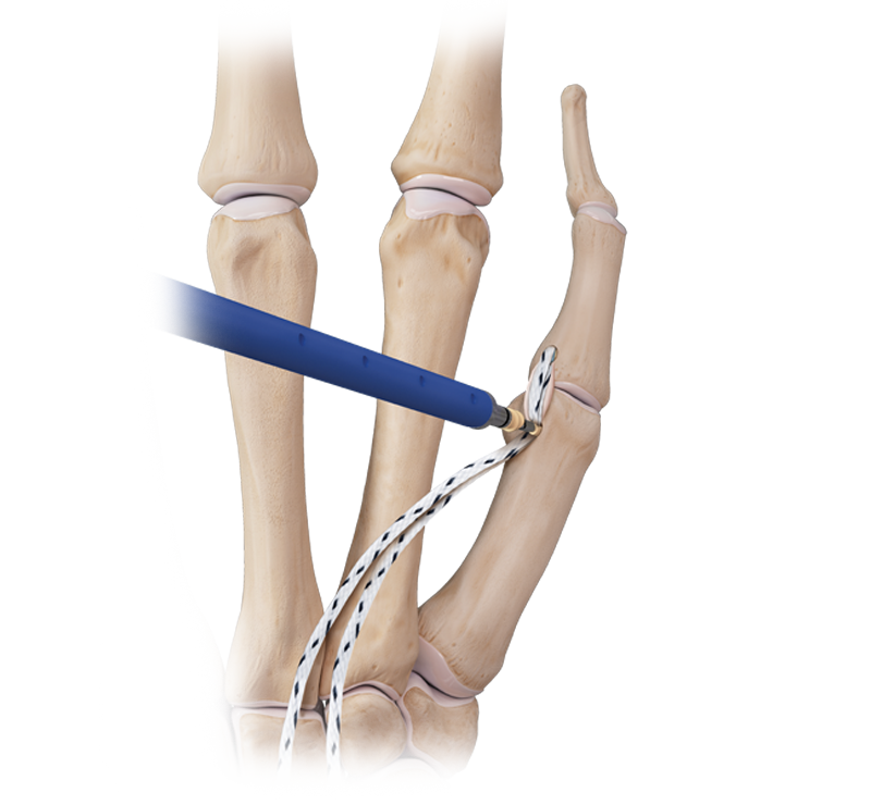 DX SwiveLock<sup>®</sup> SL Anchor Thumb Collateral Ligament Reconstruction