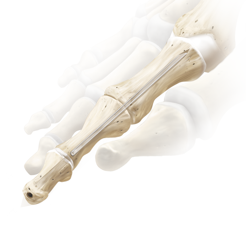 Arthrex Interphalangeal Joint Fusion