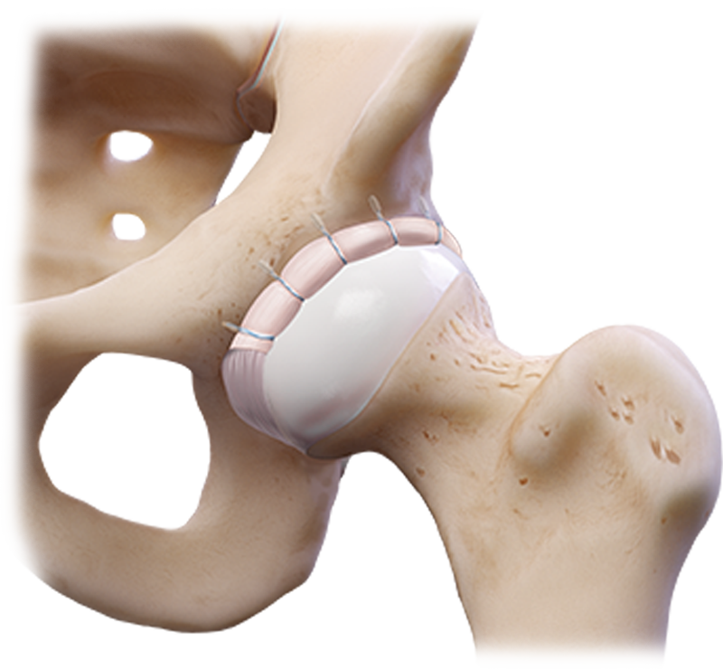 Labral Fixation