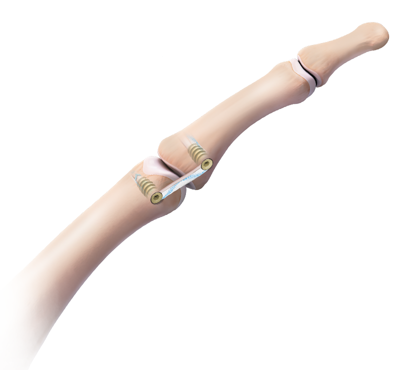 Thumb Collateral Ligament Reconstruction With Tenodesis Screws and <em>Internal</em>Brace™ Ligament Augmentation