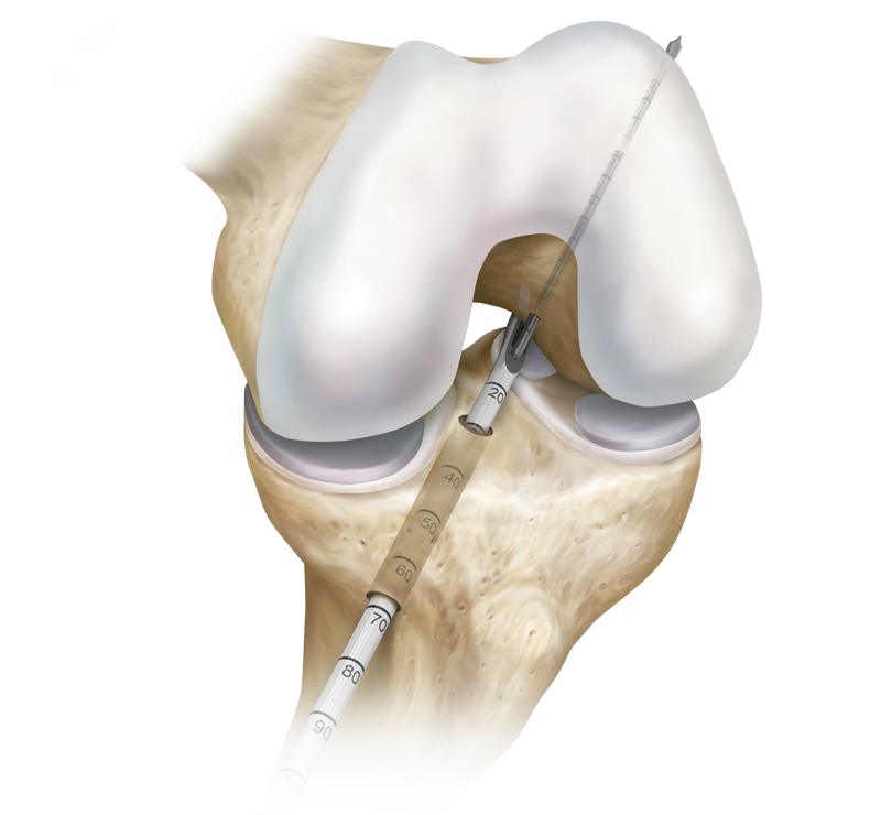 Transtibial™ ACL Reconstruction