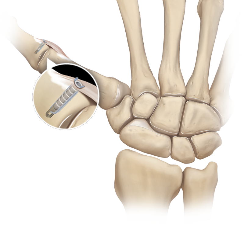 2.5 mm PushLock<sup>®</sup>  Thumb Collateral Ligament Repair