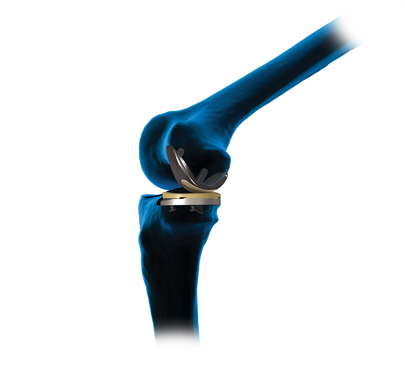 Arthrex - Unicondylar Knee Arthroplasty (UKA)