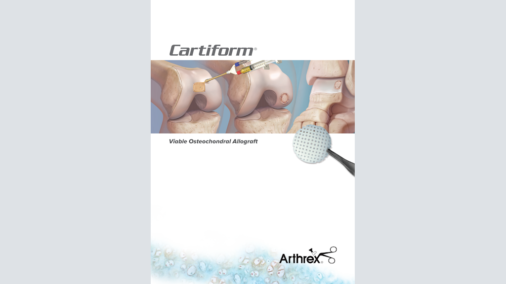 Cartiform®: Viable Osteochondral Allograft