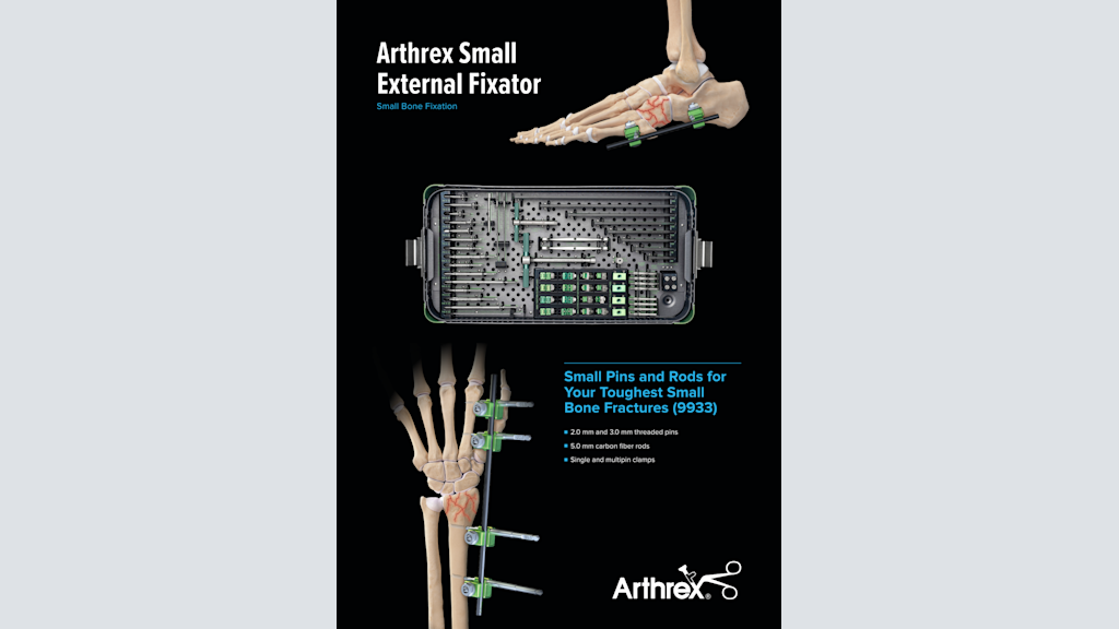 Arthrex Small External Fixator: Small Bone Fixation