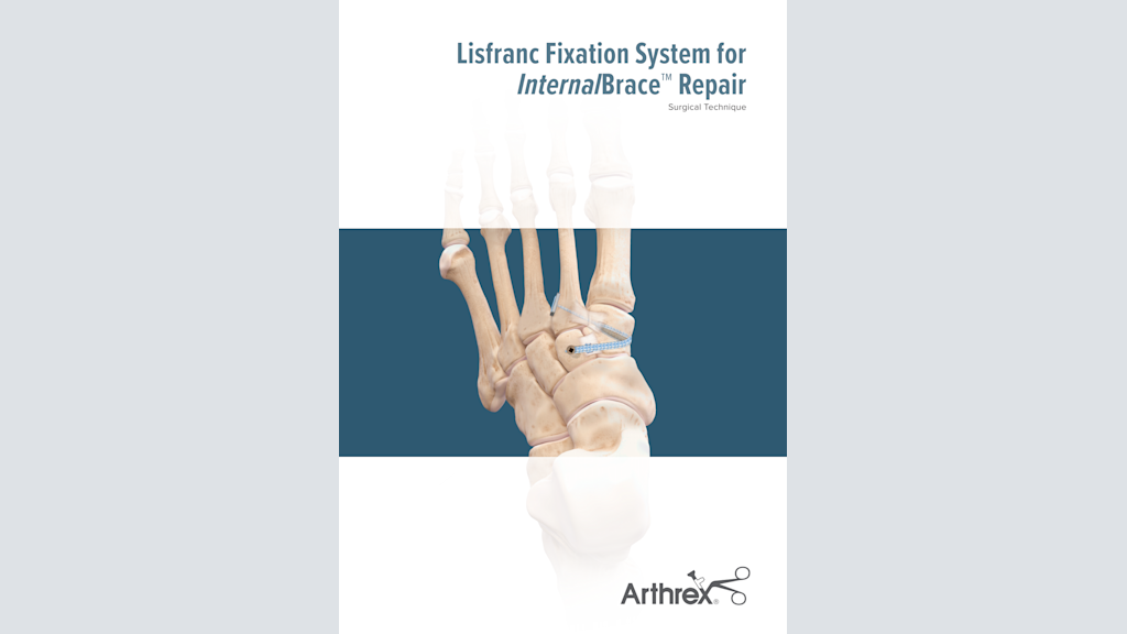 Lisfranc Fixation System for InternalBrace™ Repair