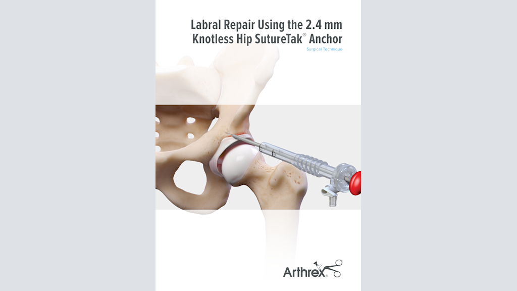 Labral Repair Using the 2.4 mm Knotless Hip SutureTak®  Anchor