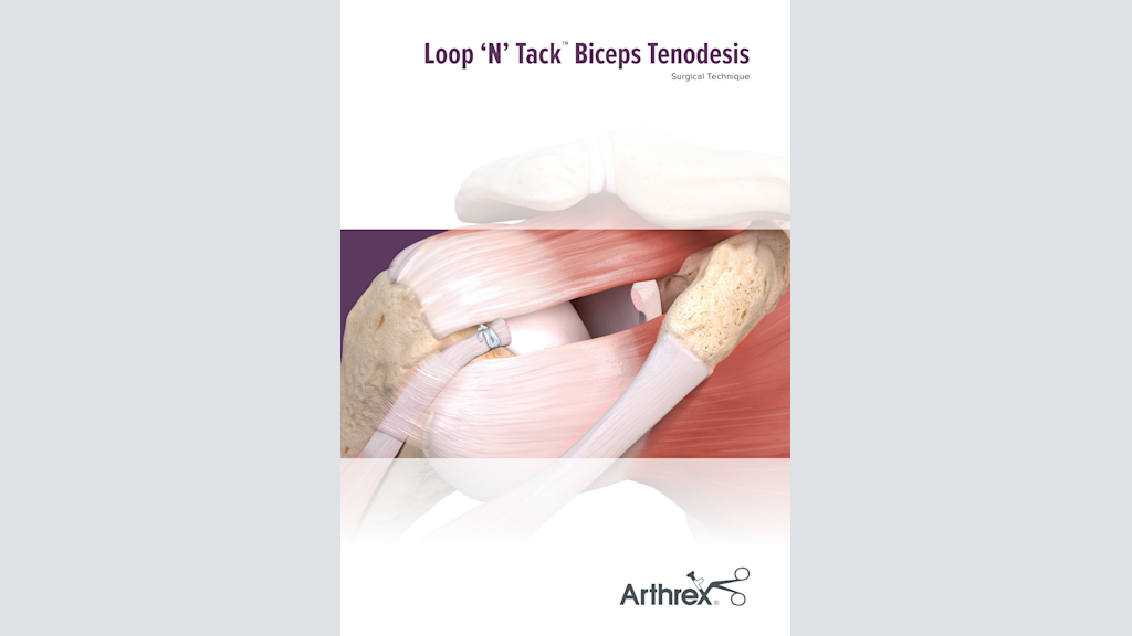Loop ‘N’ Tack™ Biceps Tenodesis