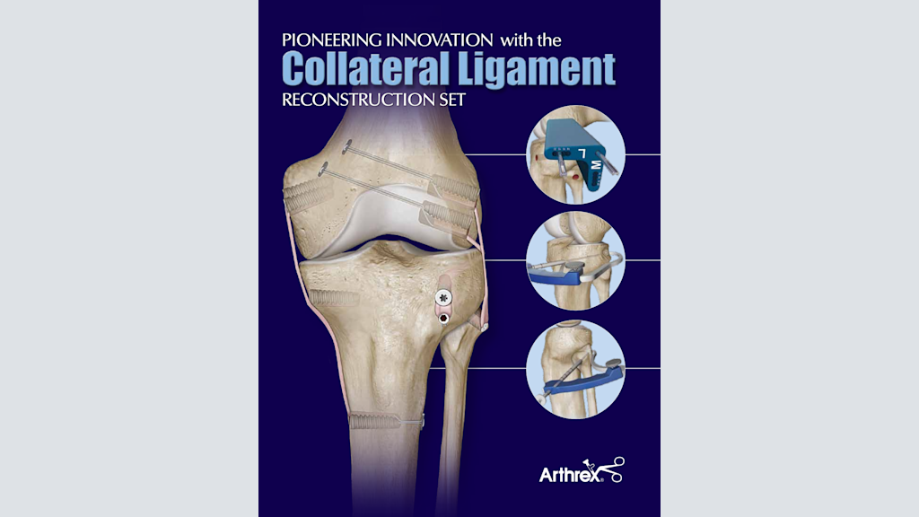 Pioneering Innovation with the Collateral Ligament Reconstruction Set