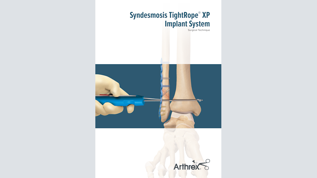Syndesmosis TightRope® XP Implant System