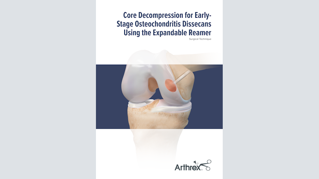 Core Decompression for Early-Stage Osteochondritis Dissecans Using the Expandable Reamer