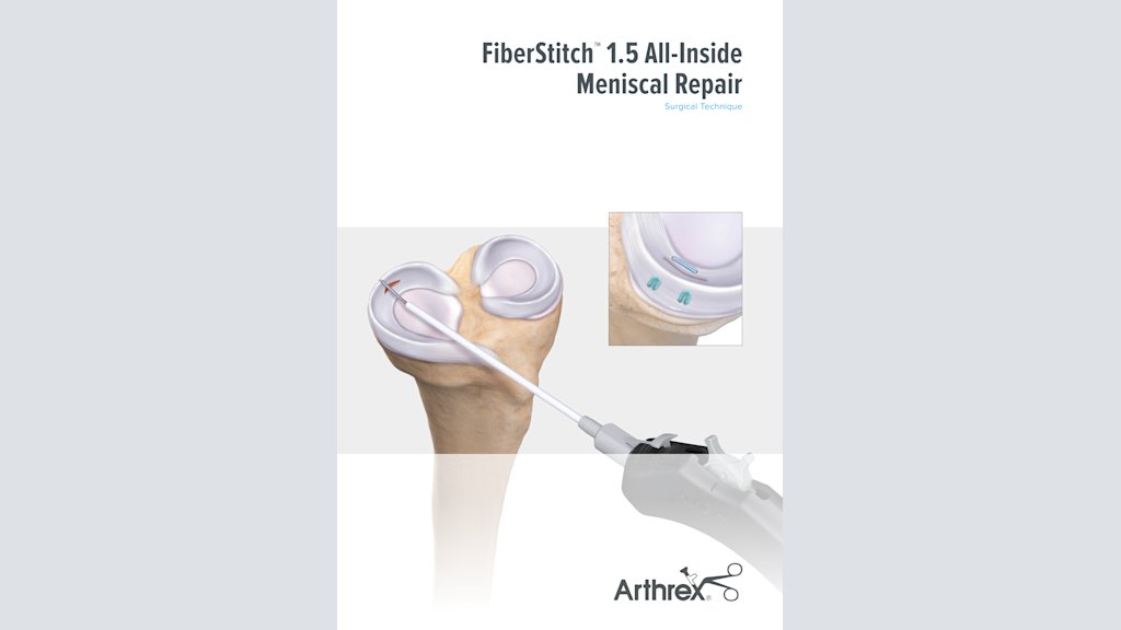 FiberStitch™ 1.5 All-Inside Meniscal Repair