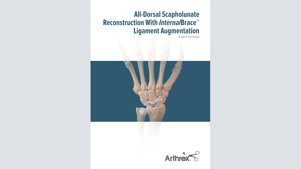 All-Dorsal Scapholunate Reconstruction With InternalBrace™ Ligament Augmentation