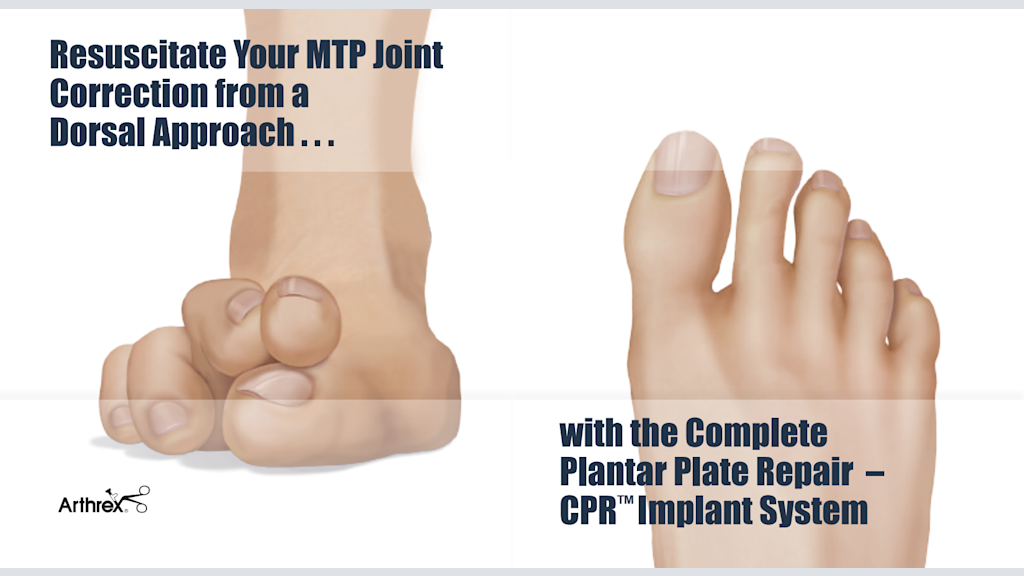 Resuscitate Your MTP Joint Correction from a Dorsal Approach with the Complete Plantar Plate Repair – CPR™ Implant System
