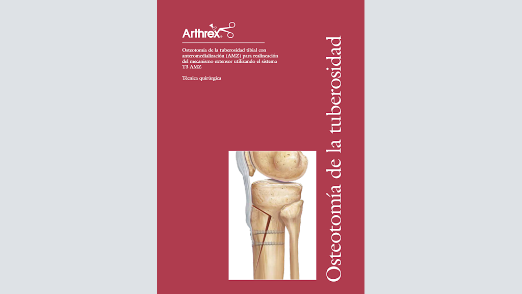 Osteotomía de la tuberosidad tibial con anteromedialización (AMZ) para realineación del mecanismo extensor utilizando el sistema T3 AMZ