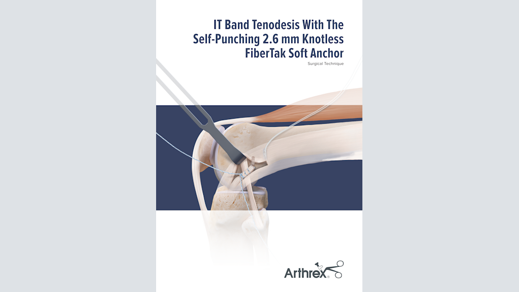 IT Band Tenodesis With The Self-Punching 2.6 mm Knotless FiberTak Soft Anchor
