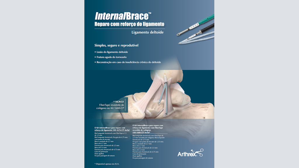 InternalBrace™ Reparo com reforço do ligamento - Ligamento deltoide