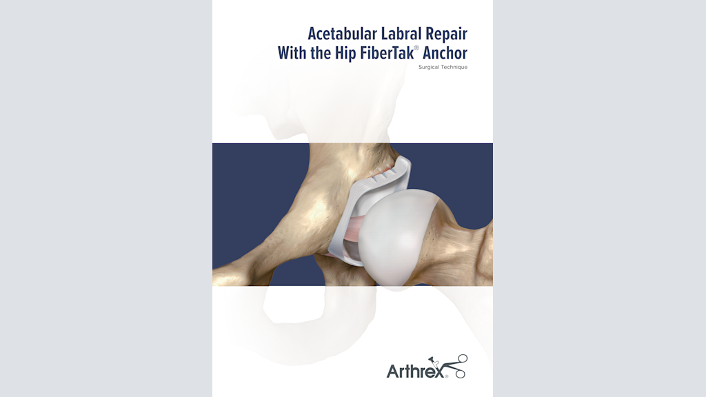 Acetabular Labral Repair With the Hip FiberTak® Anchor