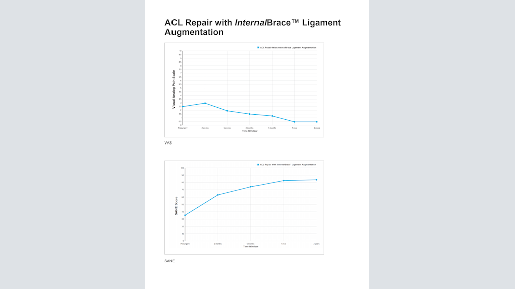 ACL Repair with InternalBrace™ Ligament Augmentation