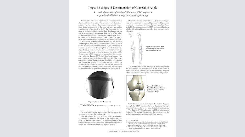 Implant Sizing and Determination of Correction Angle: A technical overview of Arthrex’s iBalance® HTO approach to proximal tibial osteotomy - preoperative planning