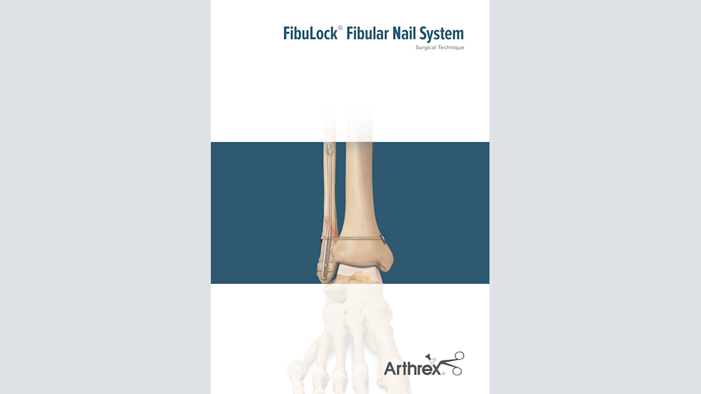 FibuLock® Fibular Nail System