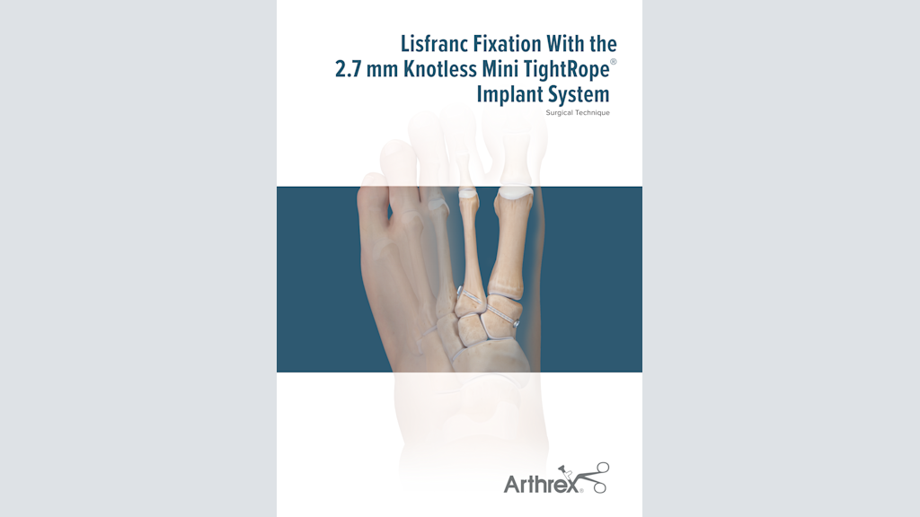 Lisfranc Fixation With the 2.7 mm Knotless Mini TightRope® Implant System