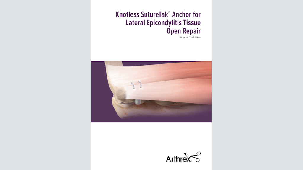 Knotless SutureTak® Anchor for Lateral Epicondylitis Tissue Open Repair