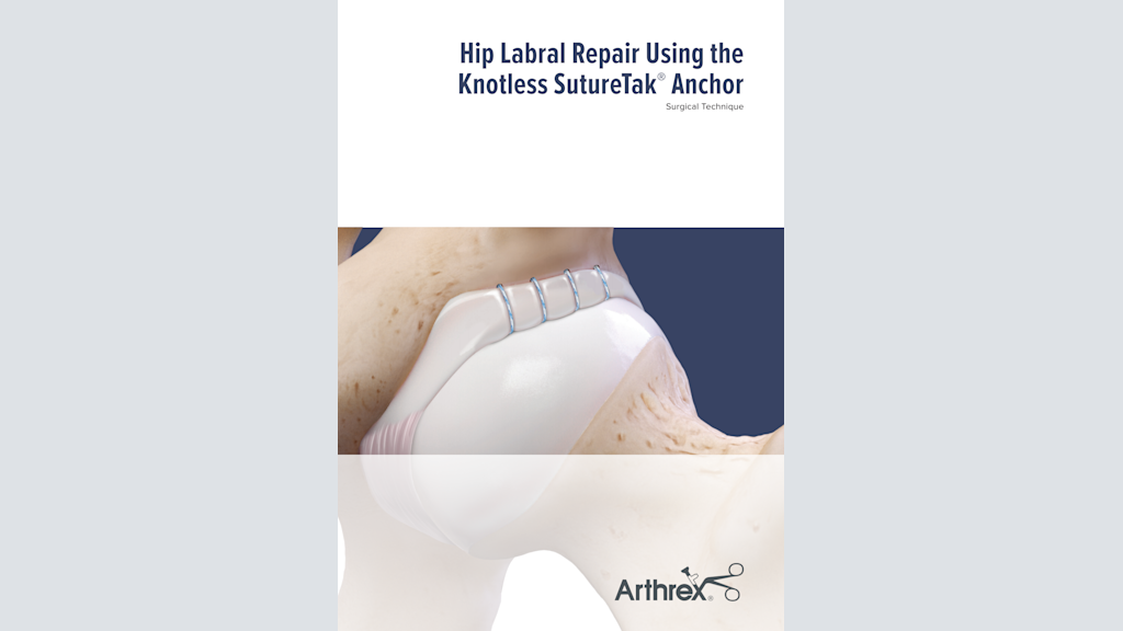 Hip Labral Repair Using the Knotless SutureTak® Anchor Surgical Technique