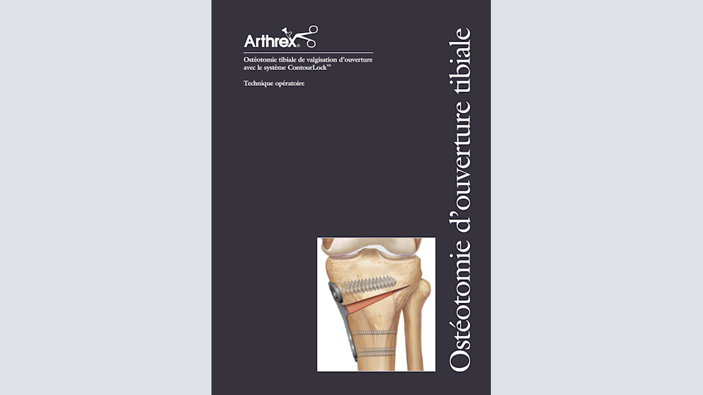 Ostéotomie tibiale de valgisation d’ouverture avec le système ContourLock®
