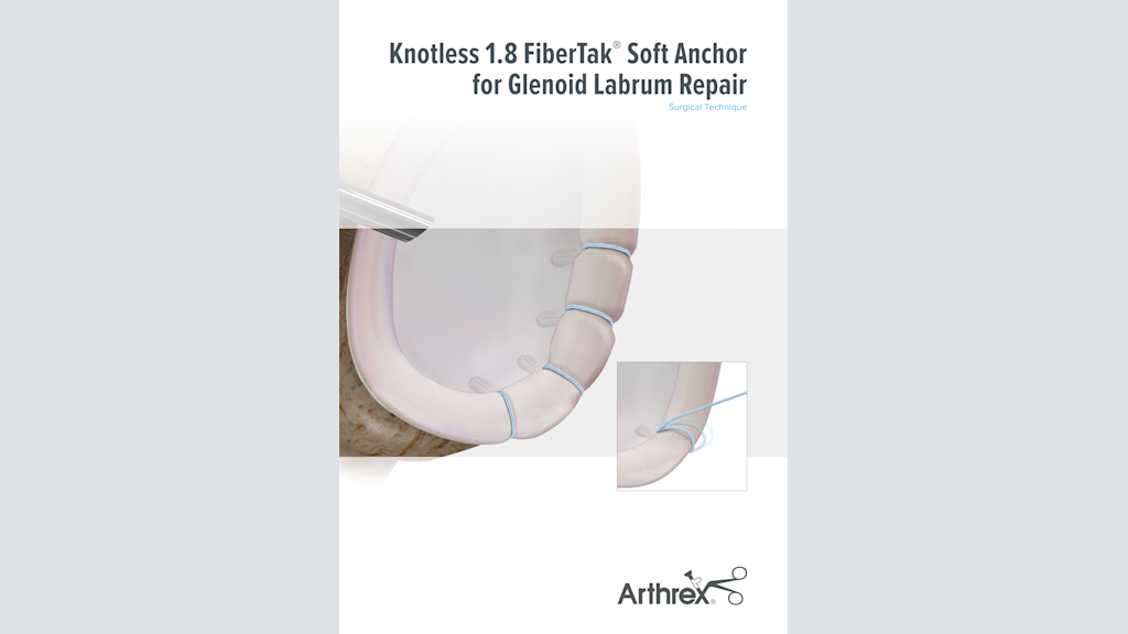 Knotless 1.8 FiberTak® Soft Anchor for Glenoid Labrum Repair