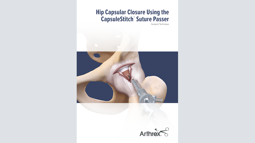 Hip Capsular Closure Using the CapsuleStitch™ Suture Passer